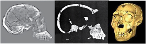 FIGURE 4.9 Images of the Homo erectus cranium KNM-WT 15000: lateral radiograph (left), parasagittal CT scan at the level of the right dental row and inner ear (middle), and 3D surface visualization extracted from a stack of CT scans (right). Unlike radiographs, CT scans have the ability to distinguish between fossil bone and the sedimentary matrix in the maxillary sinus (asterisk in center image), and to resolve details such as the root canals of the molars (arrowhead), and structures of the bony labyrinth (arrow). SOURCE: Left and middle images from Spoor et al. (2000); right image courtesy Fred Spoor, Department of Human Evolution, Max Planck Institute for Evolutionary Anthropology, Leipzig, Germany.
