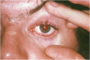 FIGURE WO-6-19 Trachoma. Chlamydia trachomatis infection can lead to conjunctivitis (as seen here) and to blindness.