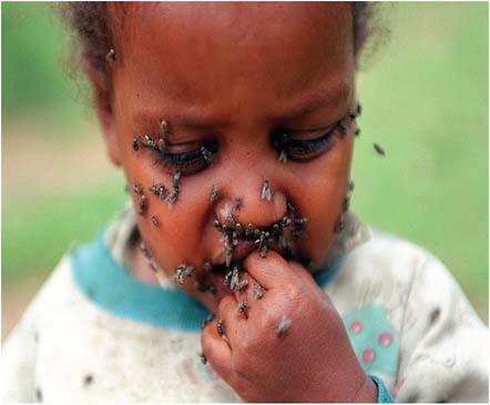 FIGURE A15-5 Child swarmed with flies, which cause infection leading to trachoma.