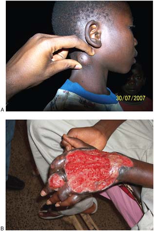 FIGURE WO-6-5 Buruli ulcer (Mycobacterium ulcerans). (A) Child presenting nodule—early sign of Buruli ulcer disease, Ghana 2009. (B) A typical Buruli ulcer on the left hand of a 17-year-old boy in Nigeria.