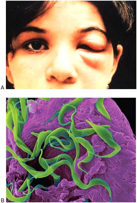 FIGURE WO-6-6 Chagas disease. (A) Acute Chagas disease in a young child. The eye sign of Romana is present. This is frequently seen in acute cases and is presumed to mark the point of entry of the parasite. (B) Trypanosome trypomastigote (Trypanosoma sp.) A hemoflagellated protozoan parasite that causes trypanosomiasis (Chagas disease, African sleeping sickness). SEM 800x magnification.