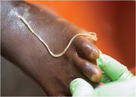 FIGURE WO-6-10 Guinea worm (Dracunculus medinensis).