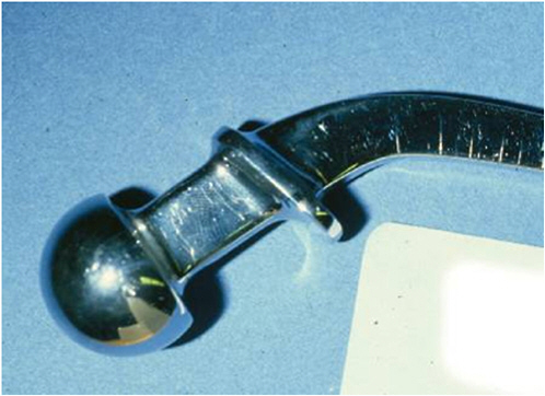 FIGURE 1.4 Femoral replacement part (T28) with stress corrosion cracking. Courtesy of Stanley A. Brown, U.S. Food and Drug Administration.
