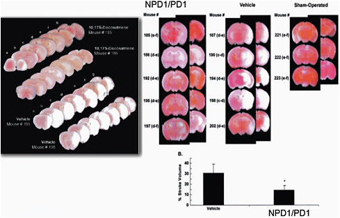 FIGURE C-17 Neuroprotective action of NPD1/PD1. NPD1 reduces stroke volume and leukocyte-mediated tissue damage in a murine model of focal ischemia in stroke. Figure is from Marcheselli et al., J. Biol. Chem. 2003; 278:43807-43817. See Bazan et al. (2010) and text for further details.