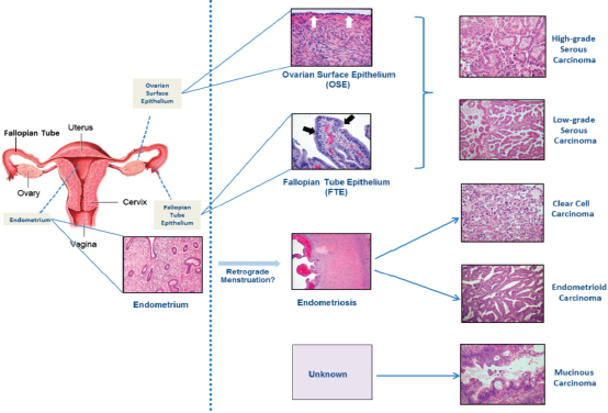 Ovarian cancer pathology. [Expression of CA-125 in ovarian cancer].